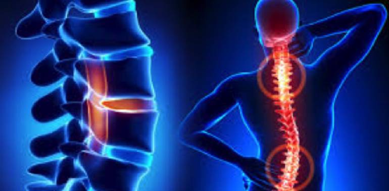 Revision Spine Surgery