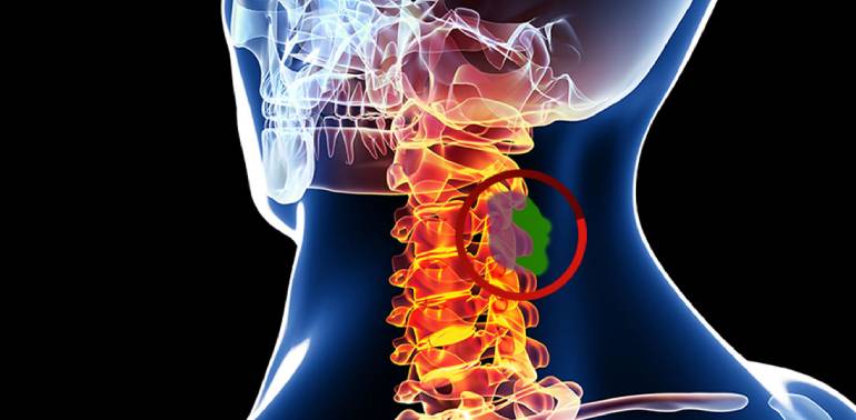 Cervical Spine Surgery