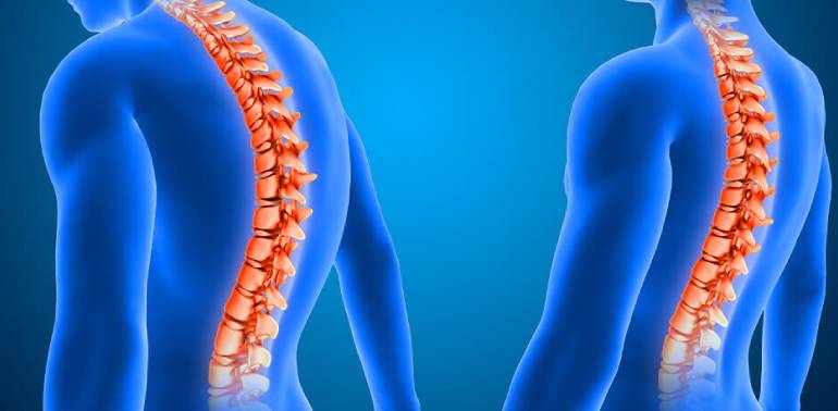 Adult Spinal Deformity Surgery